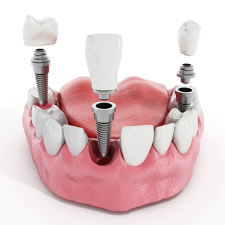 The True Cost of Dental Implants: What Factors Influence Pricing?